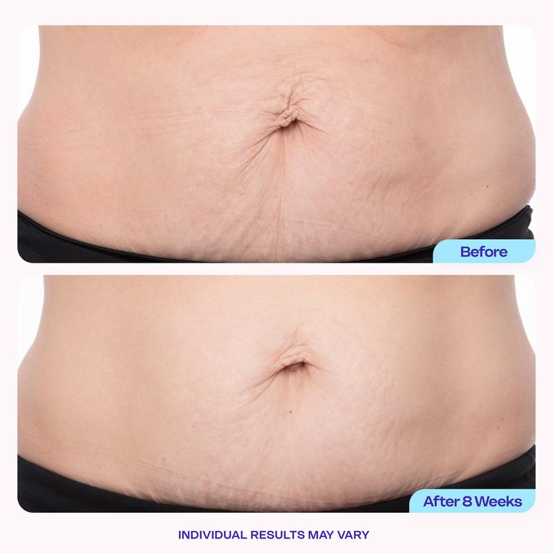Resplenza™ SculptTone Belly Firming & Smoothing Cream